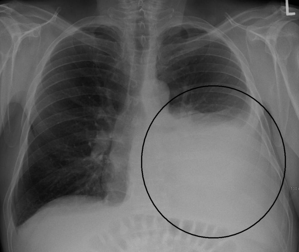 Traitement standard de pneumonie ambulatoire